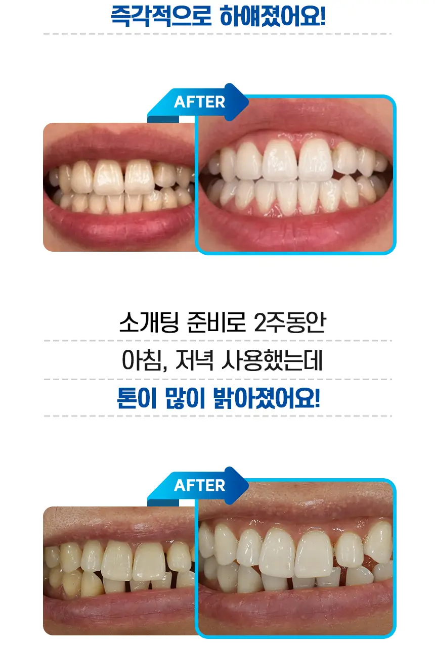 [NEW] 브리올 화이트닝 치아 미백제 4g (치과미백 동일성분) 상세페이지 19